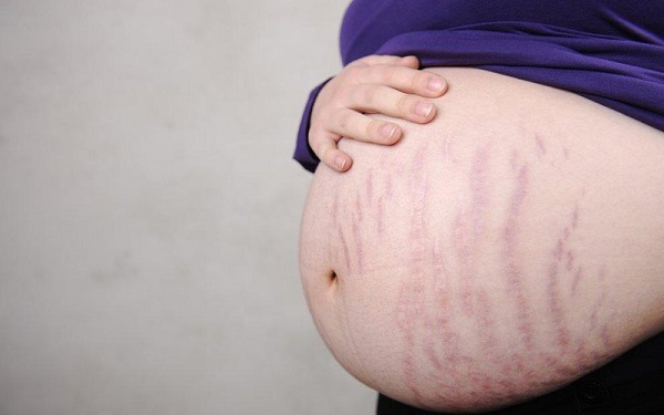 rạn da khi mang thai