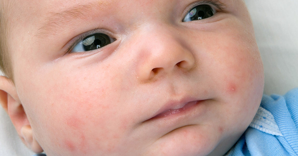 Những điểm bát thường trên da của trẻ sơ sinh