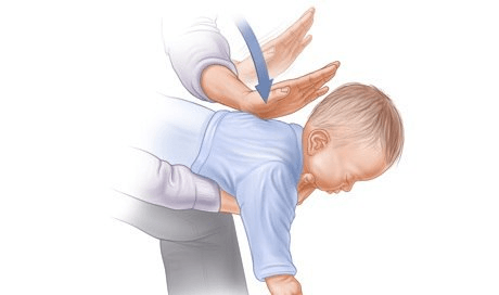 Động tác xử lý khi bé bị sặc sữa