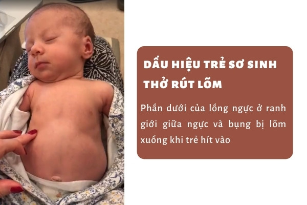 Dấu hiệu trẻ bị viêm phổi dễ nhận biết nhất là bụng bị lõm xuống khi trẻ hít vào