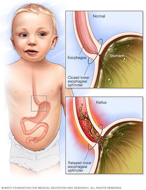 Cơ thắt thực quản dưới vẫn chưa phát triển hoàn toàn là một trong những nguyên nhân gây trào ngược dạ dày thực quản ở trẻ sơ sinh.