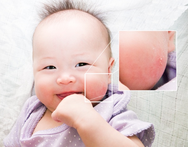 bệnh ngoài da ở trẻ sơ sinh