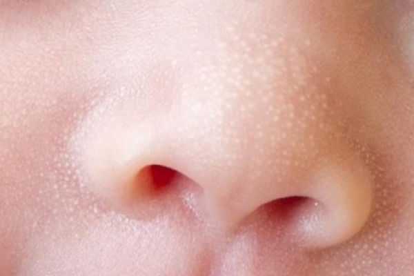 các bệnh ngoài da ở trẻ sơ sinh