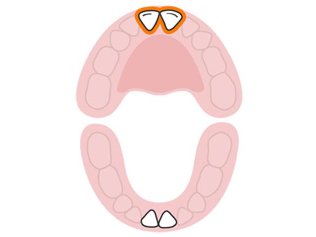 Răng cửa giữa hàm trên