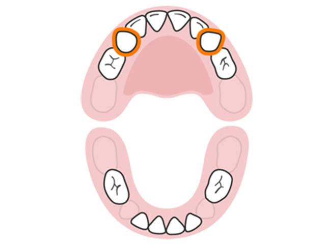 Răng nanh hàm trên